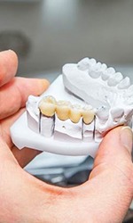 Dental bridge on a clay model