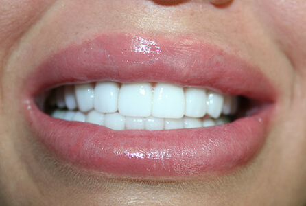 Perfect smile after treatment