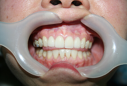 White healthy teeth after treatment