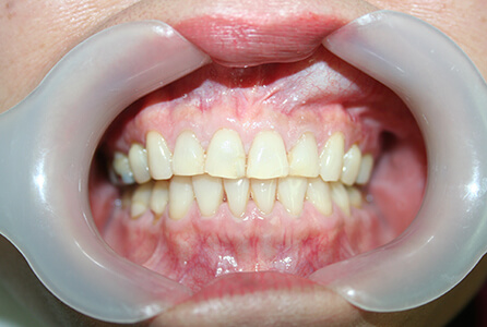Yellow teeth before treatment