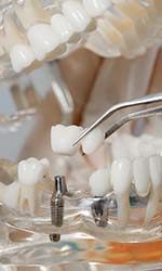 Dentist holding dental implants in Studio City replacing multiple missing teeth