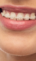 Clear and ceramic braces