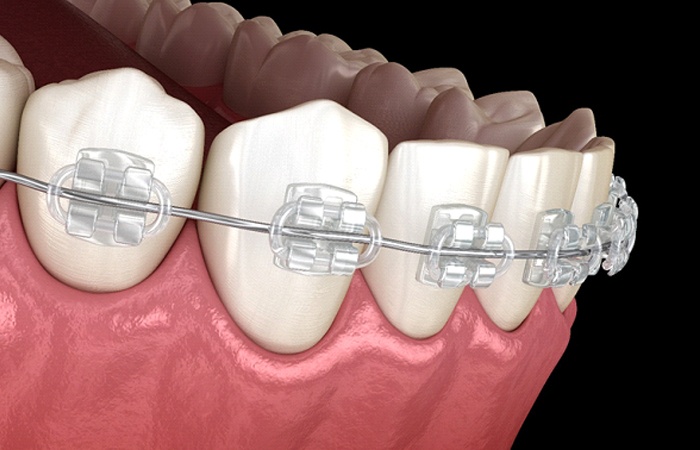 computerized model of clear braces