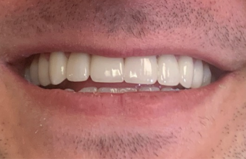 Closeup of flawless smile after cosmetic treatment
