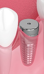 Digital illustration of dental implant in Studio City