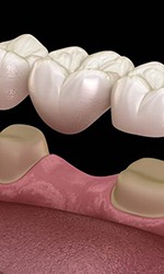 Digital illustration of a dental bridge