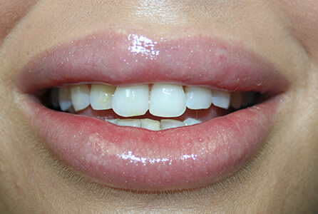 Oversized front teeth before treatment