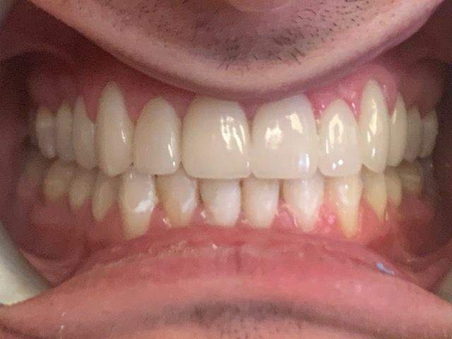 Properly aligned teeth after treatment