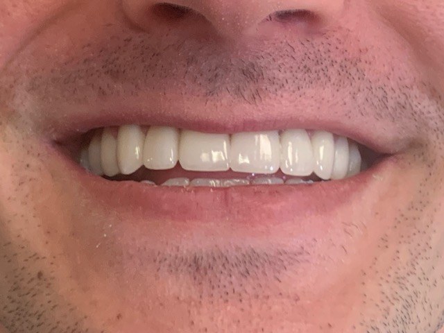 Properly aligned bottom teeth after treatment