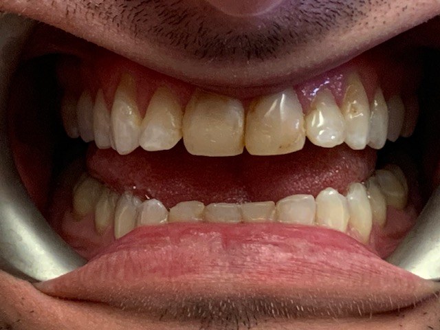 Crooked and overlapping bite before treatment