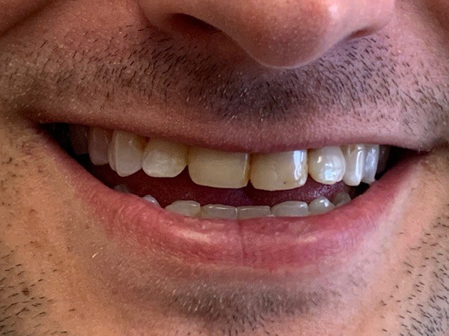 Crooked bottom teeth before treatment