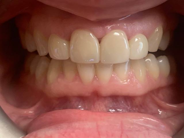 Properly aligned teeth after treatment