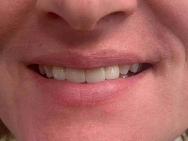 Properly aligned bottom teeth after treatment