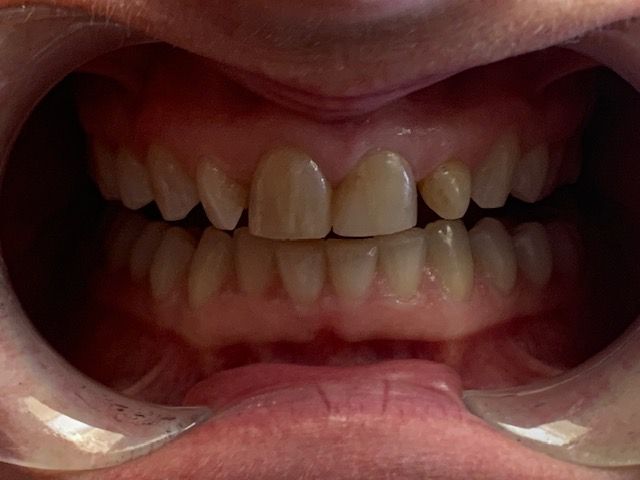 Crooked and overlapping bite before treatment