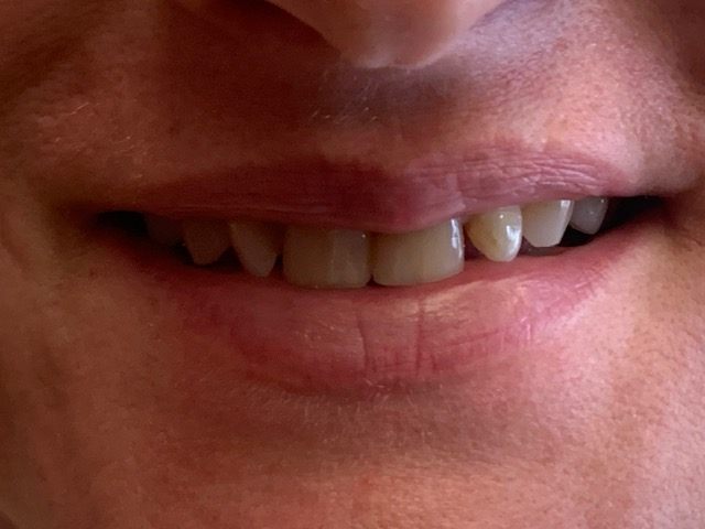 Crooked bottom teeth before treatment