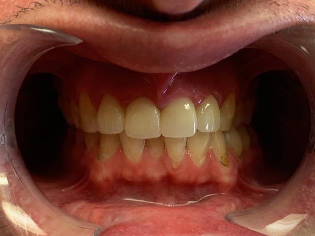 Properly aligned bottom teeth after treatment