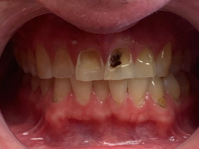 Crooked bottom teeth before treatment