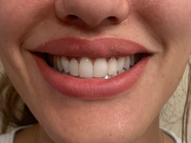 Properly aligned bottom teeth after treatment