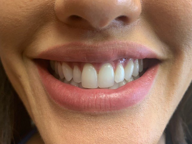 Crooked bottom teeth before treatment