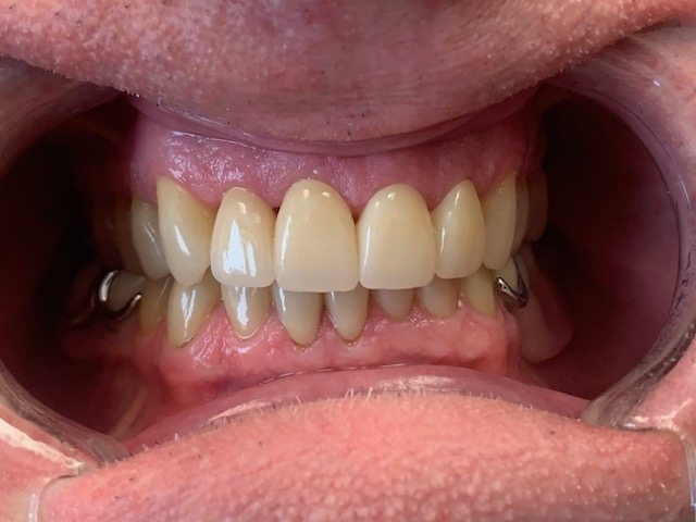 Properly aligned bottom teeth after treatment