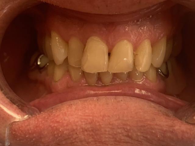 Crooked bottom teeth before treatment