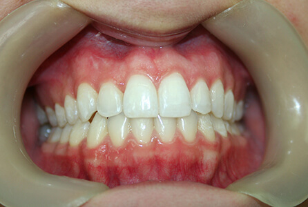 Properly aligned teeth after treatment