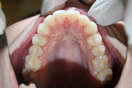 Properly aligned bottom teeth after treatment