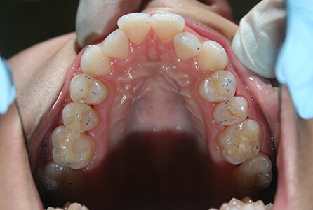 Crooked bottom teeth before treatment