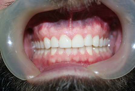 Closed gap between teeth after treatment