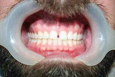 Gap between front teeth before treatment