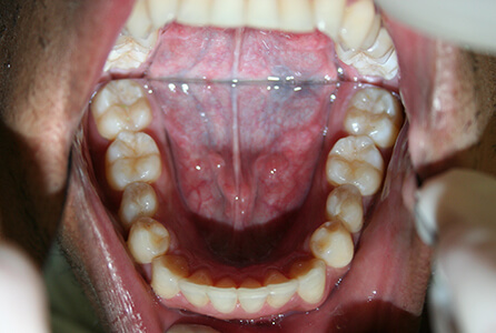 Properly aligned and spacd bottom teeth