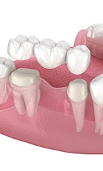 A 3D illustration of a traditional dental bridge in Tyler