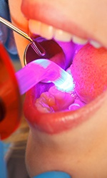 Closeup of smile during dental bonding