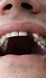 Man showing space where a tooth once existed