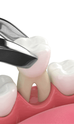 Illustration of forceps pulling a tooth 