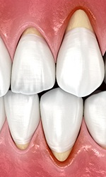 Digital view of gum recession