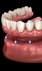 Implant denture in Studio City