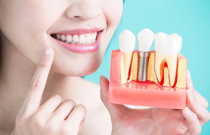 Dentist pointing to teeth holding model of dental implants in Studio City
