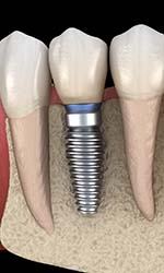 Digital illustration of a single tooth dental implant in Studio City