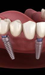 digital diagram of implant dentures in Studio City