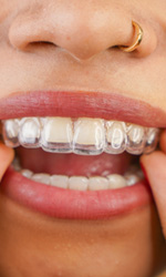 Woman putting in Invisalign