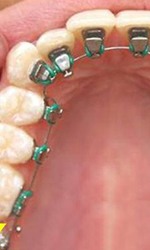 Lingual braces