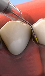 Animation of antibiotic therapy