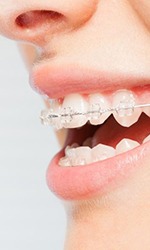Close-up of woman’s smile with clear braces on upper teeth