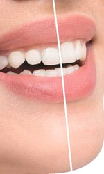 womans smile before and after gum recontouring