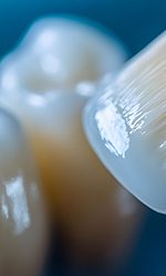 A brush applying a dental sealant to a back tooth