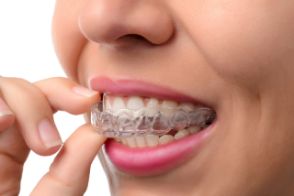 Woman putting in a clear aligner tray 