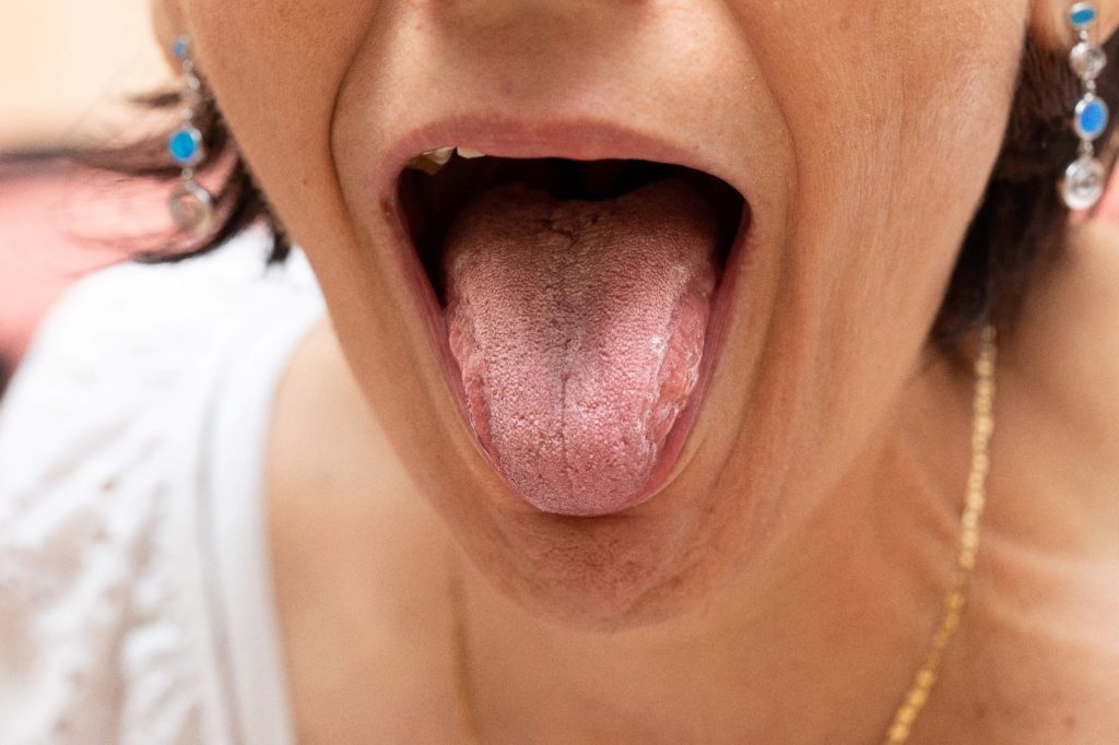 Closeup of woman with white film on tongue
