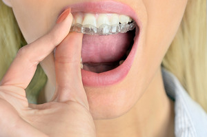 Woman putting a nightguard on her teeth