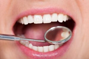 Closeup of a mouth being examined with dental mirror